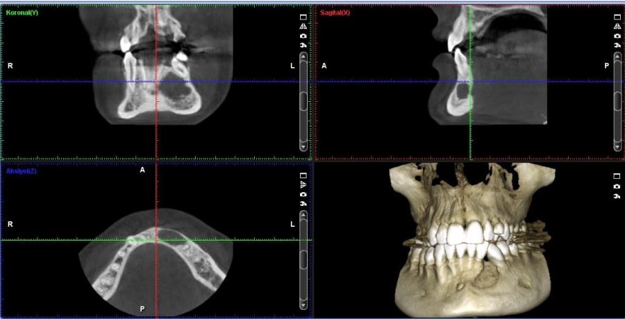 Volumetrik Dental Tomografi
