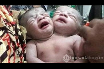 İki başlı mucize bebek