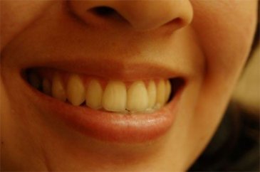 Bunu yapın dişlerinizin sararmasını engelleyin
