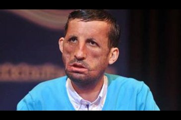 İlk yüz nakilli Uğur Acar hastaneye kaldırıldı	

