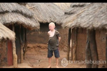 Tanzanya'da albino cinayeti
