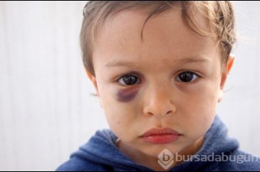 Çocuğunuzda sebepsiz morluklar varsa dikkat!
