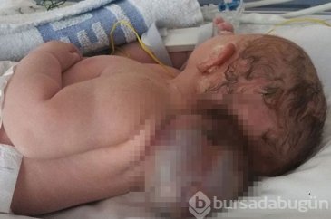 Beyni kafatasının dışında büyüdü
