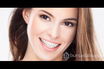 Diş teli tedavisinde doğru bilinen 5 yanlış