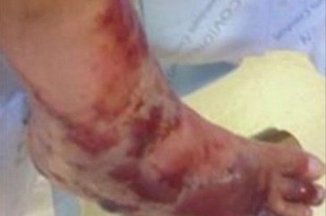Denize ayaklarını soktu 4 gün sonra bacağı kesildi