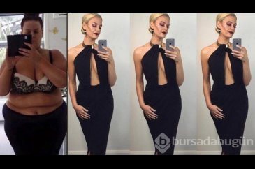90 kilo verdi şimdi de estetik yaptırıyor
