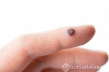Siğiller için ev yapımı doğal tedaviler