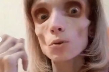 Anoreksiya hastası Kristina Karyagina 17 kilo
