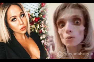 Tedavi olmazsa ölecek! Sadece elma ve muzla beslenerek 17 kiloya dü...