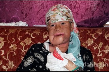 Çenesinde çıkan sivilceyi önemsemedi, hayatı karardı
