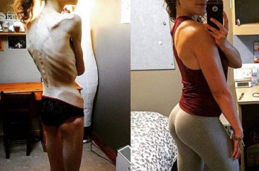 Emelle Lewis anoreksiya hastası olmuştu, son hali görenleri şaşırtt...