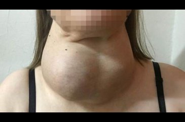 Ameliyattan korktu yıllarca böyle yaşadı
