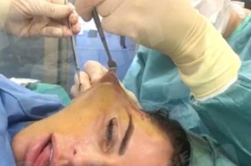 Ünlü isim yüz germe ameliyatının videosunu paylaştı