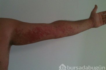 İnatçı sedefe biyolojik ilaç

