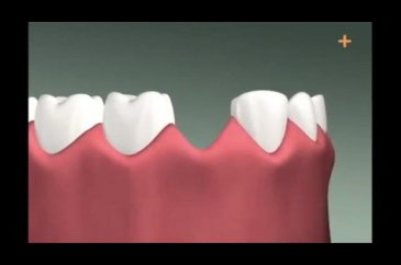 Diş implantı böyle yapılıyor


