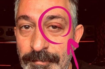 Cem Yılmaz'ın gözüne ne oldu?

