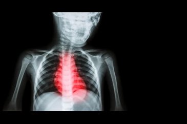 Çocukluk çağı kalp krizleri basit bir EKG ile önlenebilir (Ani kalp...