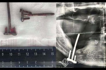 İmplant tedavisi diye gitmişti! 28 yıl sonra ortaya çıkan gerçek de...