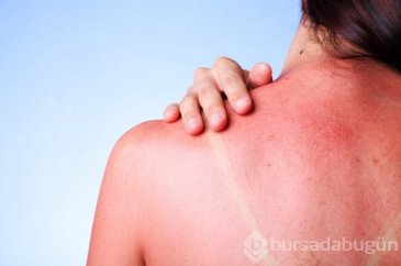Güneş yanığına ne iyi gelir?