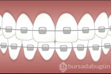 Beklemek zorunda değilsiniz! İşte tüm detaylarıyla hızlı diş teli t...