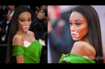 Winnie Harlow: Güzellik Algısını Baştan Yaratan Kadın!
