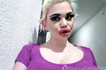 Dudağına 20'den fazla dolgu yaptırdı!