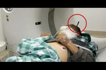 20 cm'lik mıh kafatasını kırıp beynine saplandı! 