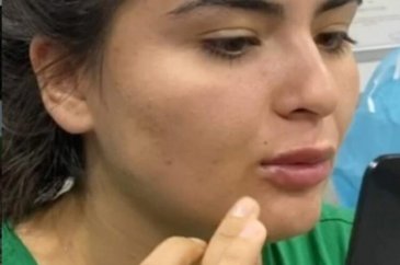 Hanife Gürdal dudaklarına dolgu yaptırdı