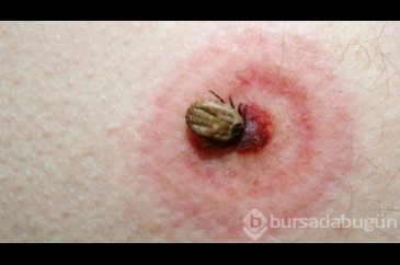 Lyme hastalığı nedir? Nelere dikkat edilmelidir?
