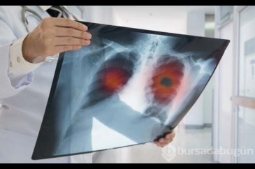 Akciğer kanserinde erken tanı vurgusu!