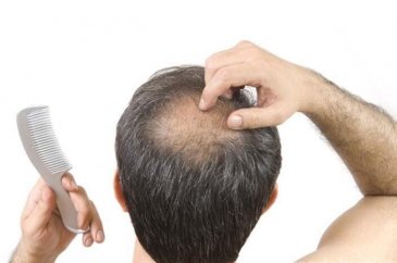 Saç ekiminde doğru bilinen yanlışlar