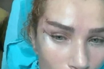 Seda Sayan tatil dönüşü direk estetik yaptırdı
