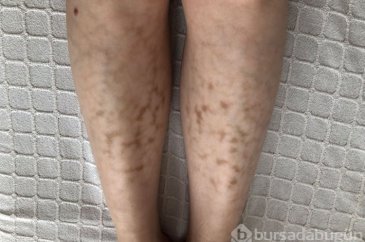 Dizüstü bilgisayar kullananlar dikkat! Hastalığa davetiye çıkıyor