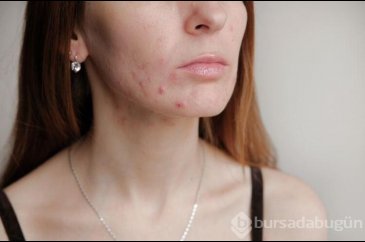 Aşırı yağlı ve sivilceli ciltler için günlük bakım
