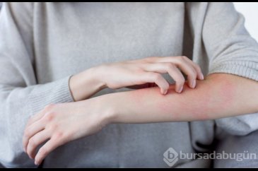 9 soruda bahar alerjiniz olup olmadığını öğrenin 
