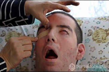 Görme bozukluğuyla başladı, 10 yıldır gözlerini kapatamıyor