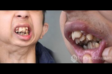 Liseli gencin dramı! Çenesi yok, dişleri üst damağında
