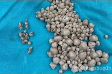 Tayvan'da şoke eden görüntü! Kadının böbreklerinden 300 taş çıkarıldı