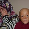Türkiye'nin ilk yüz nakli küçük Buse'yi umutlandırdı