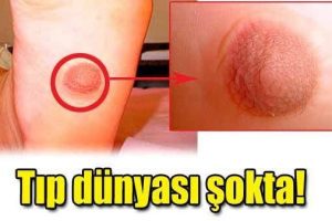 Ayak tabanında çıkan göğüs ucu doktorları bile şok etti