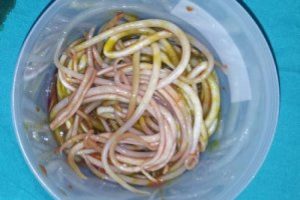 3 yaşındaki çocuktan 2 kilo solucan çıktı
