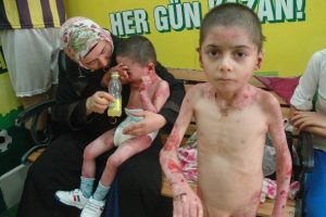 İki kardeşin her gün derileri soyuluyor