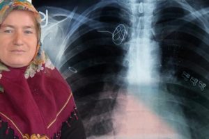 Vücudunda tel unutulan hastaya 30 bin lira tazminat!