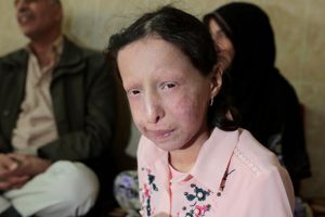 Nadir hastalığa yakalanan Suriyeli Zeve kardeşi gibi ölmek istemiyor