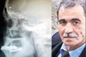 Kafasında 40 yıl mermi ile yaşadı!