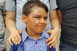 Bursa'da tatilden dönen minik Efe'nin yüzüne kaynar su döküldü