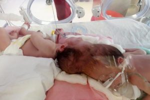 'Siyam ikizleri'nin yaşam mücadelesi