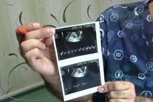 Stres yüzünden 19 yıl çocuğu olmadı