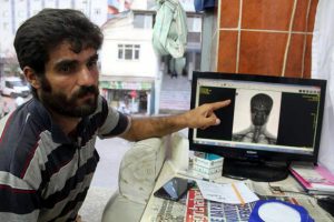 Başında 80 saçma ile yaşıyor