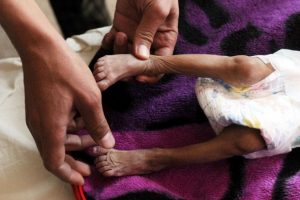 Yemen halkının yüzde 80'i yardıma muhtaç